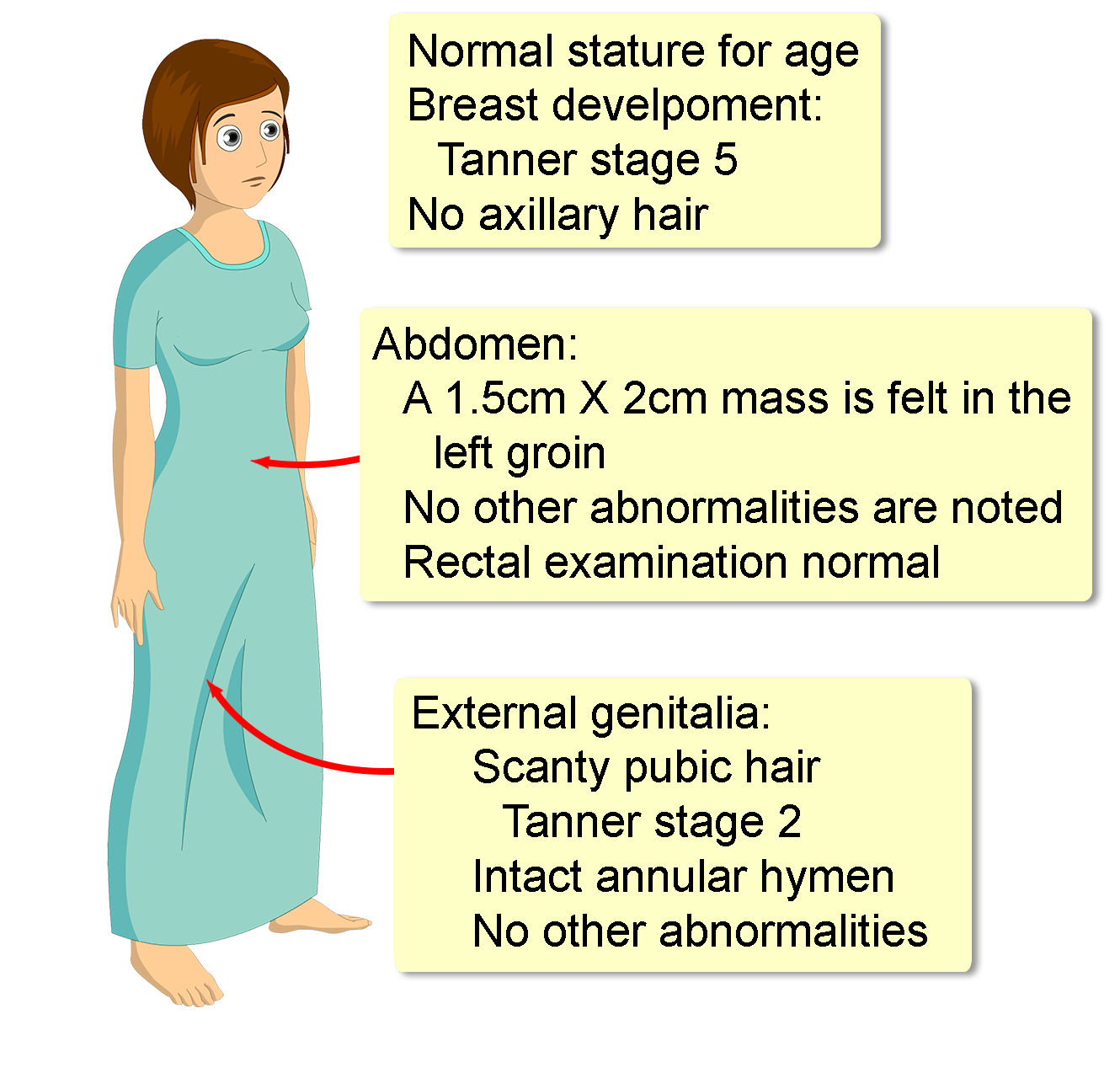 Complete Androgen Insensitivity Syndrome Diagram