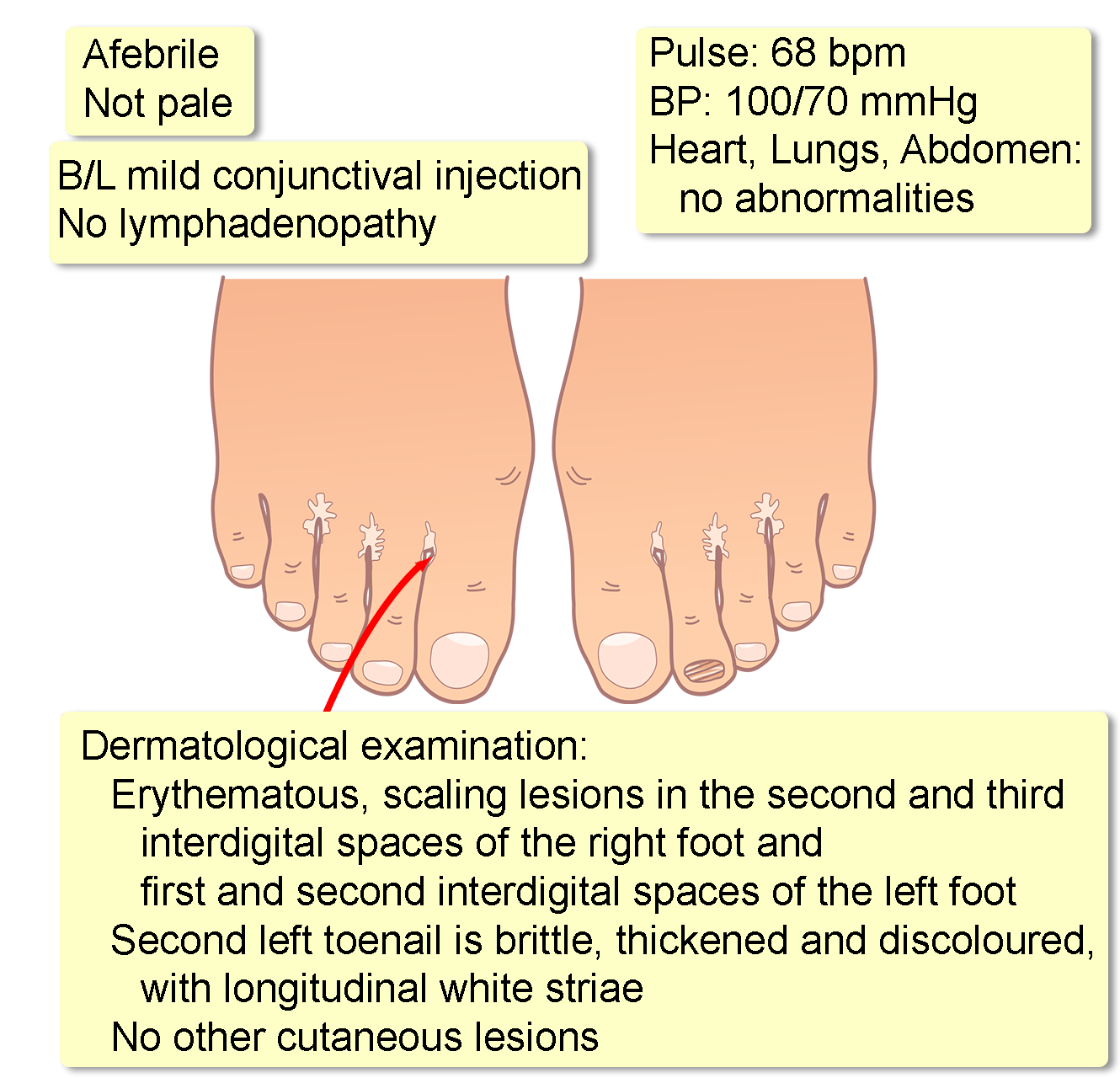 Tinea Pedis / Manuum - Dermatology - Medbullets Step 1