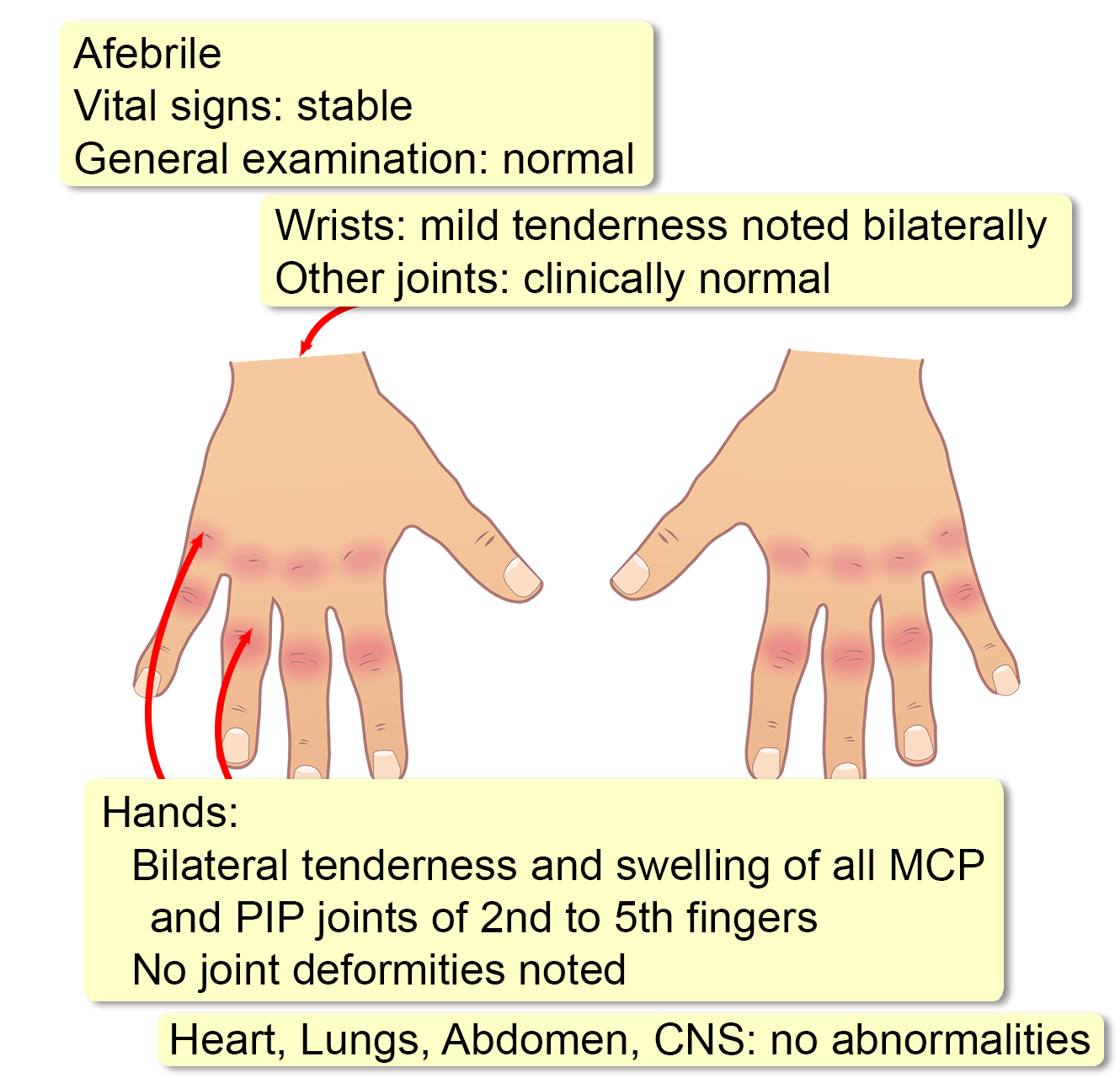 case study on rheumatoid arthritis