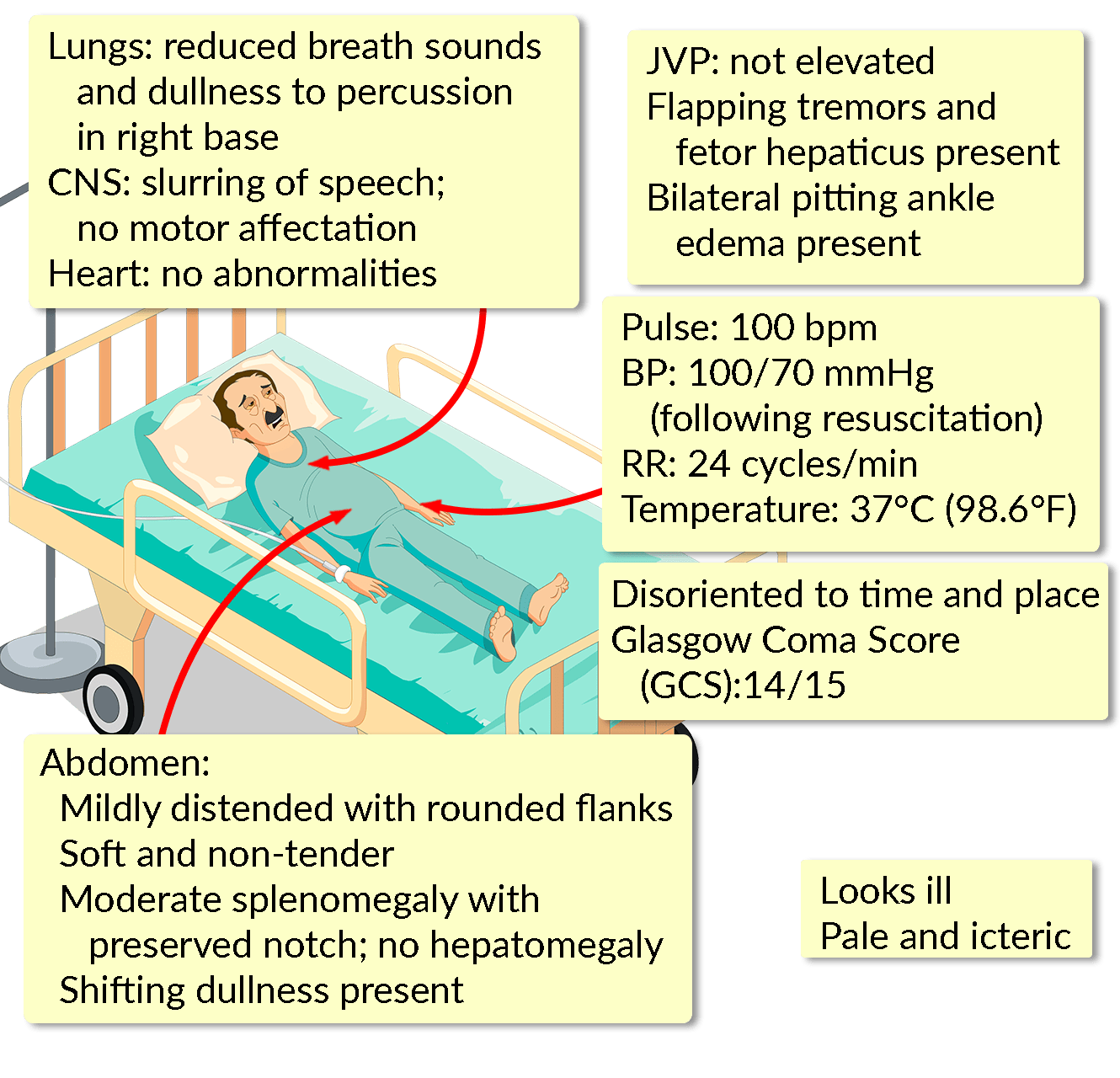 Fetor Hepaticus