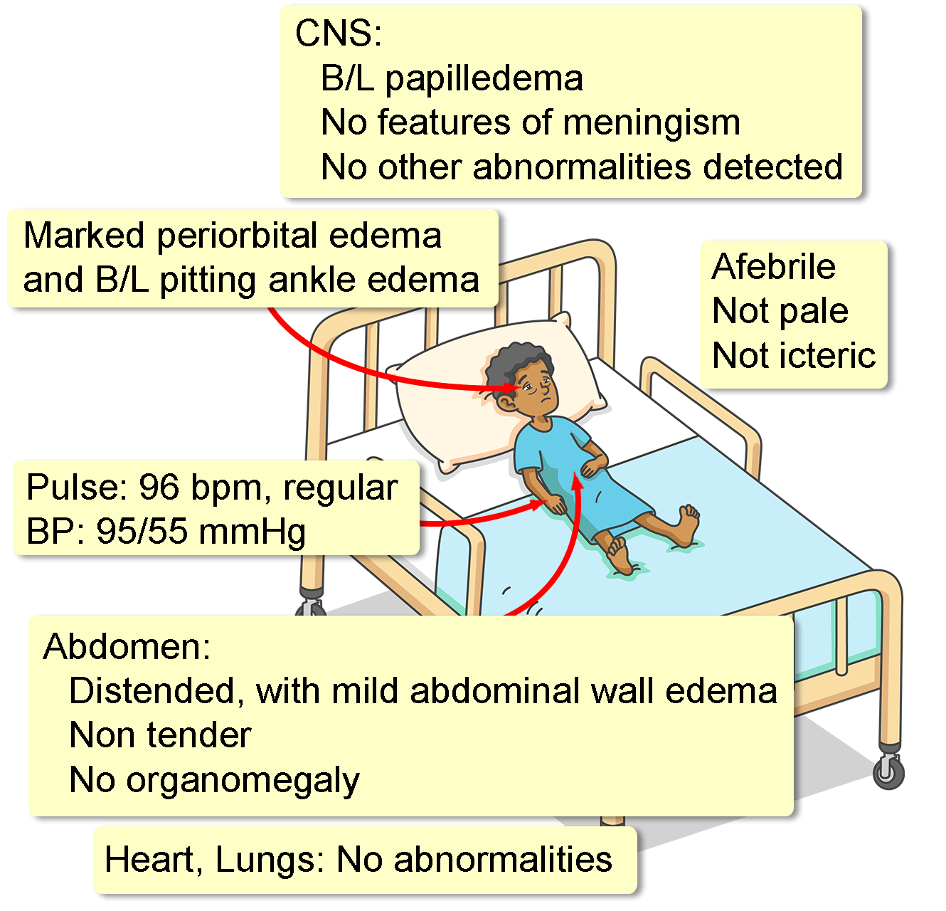 Periorbital Edema Nephrotic Syndrome