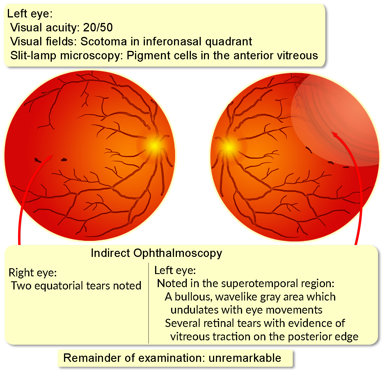 causes and symptoms of detached retina